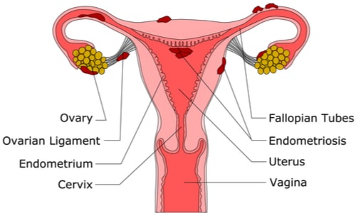 Image of a woman's reproductive system with endometriosis